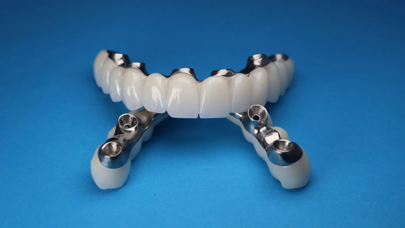 Prótesis fija de arcada completa sobre implantes tipo All-on-4, con sus conexiones de titanio