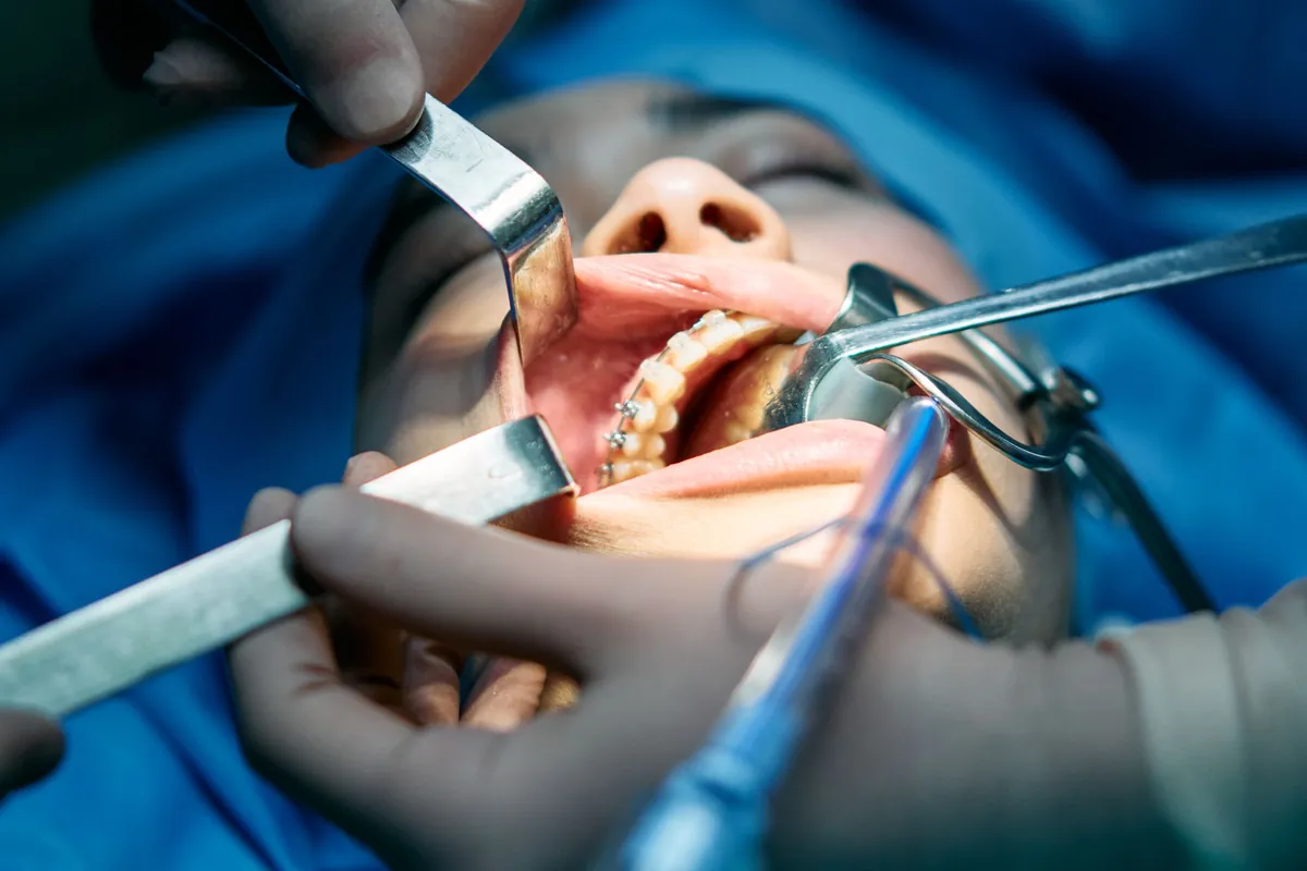 Equipo odontológico durante la cirugía de colocación de implantes con carga inmediata