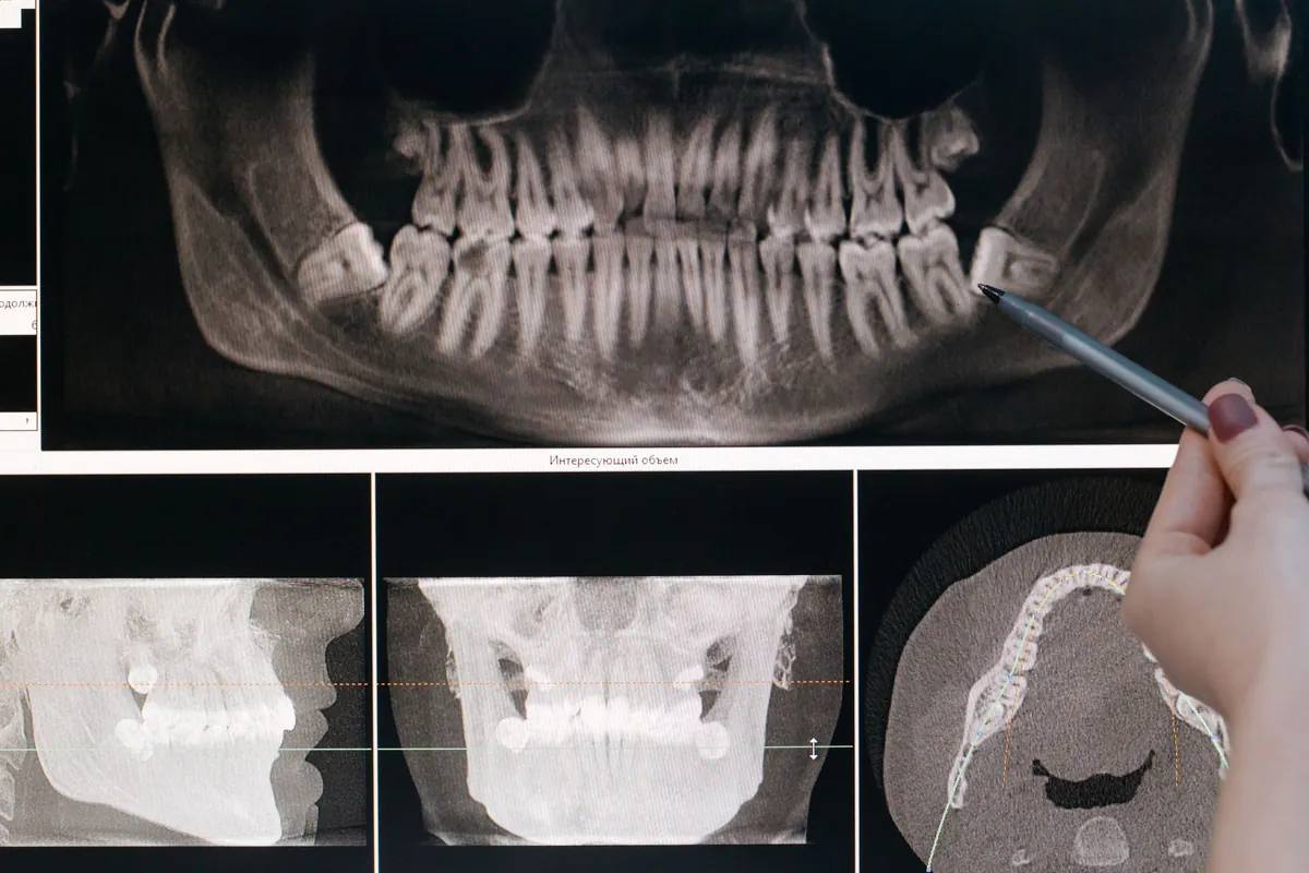 Planificación de una carga inmediata sobre el TAC dental y la radiografía panorámica del paciente
