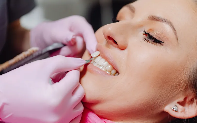 Dentista comprobando el color de las carillas dentales con una guía de tonos en la sonrisa de una paciente
