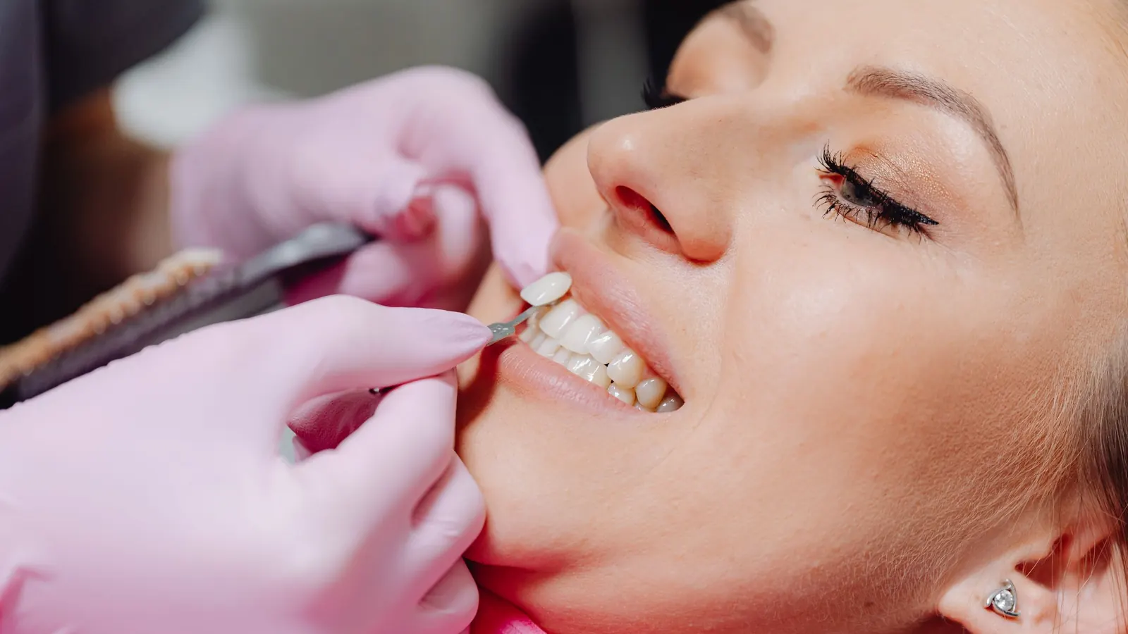 Dentista comprobando el color de las carillas dentales con una guía de tonos en la sonrisa de una paciente