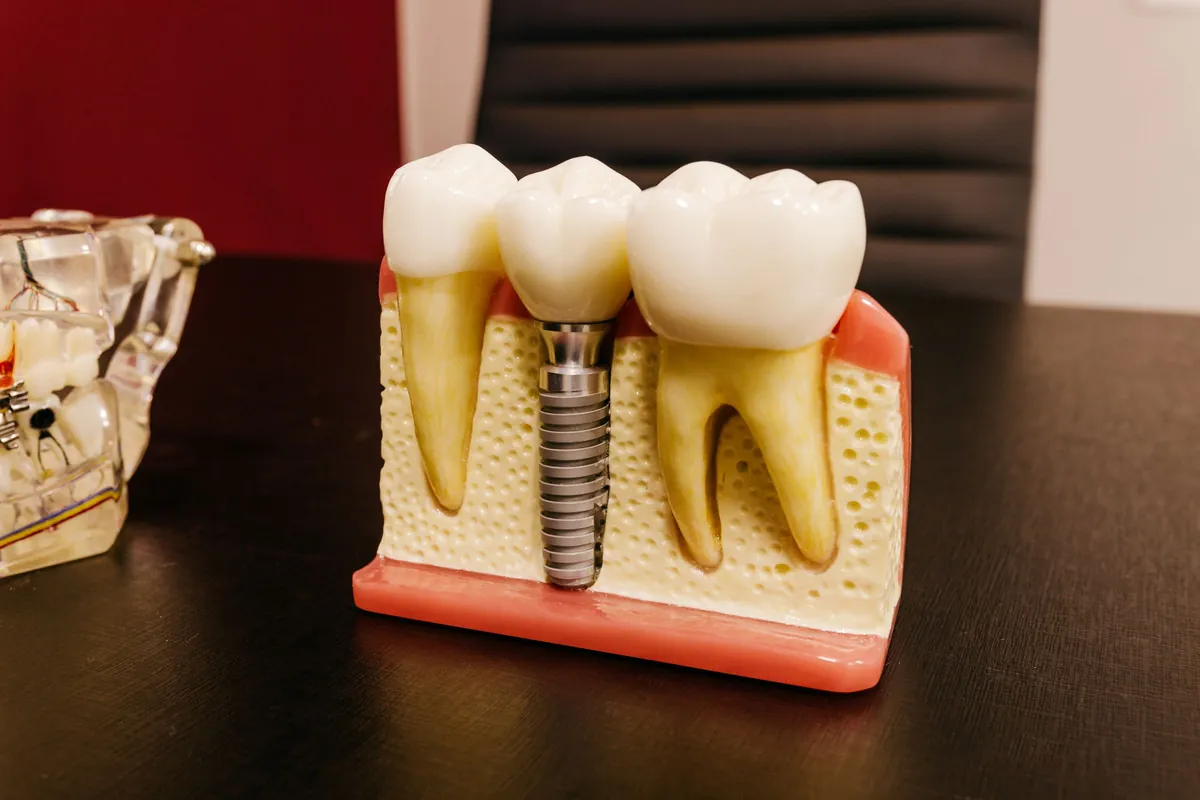 Maqueta con una corona sobre implante junto a dientes naturales para comparar ambas estructuras