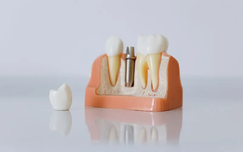 Maqueta de un implante dental con su pilar y la corona sobre implante colocada al lado