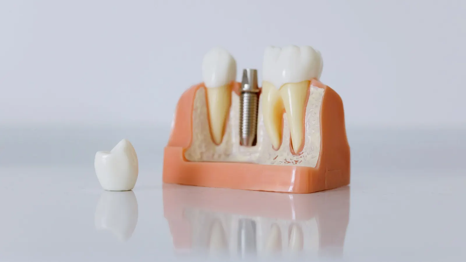 Maqueta de un implante dental con su pilar y la corona sobre implante colocada al lado