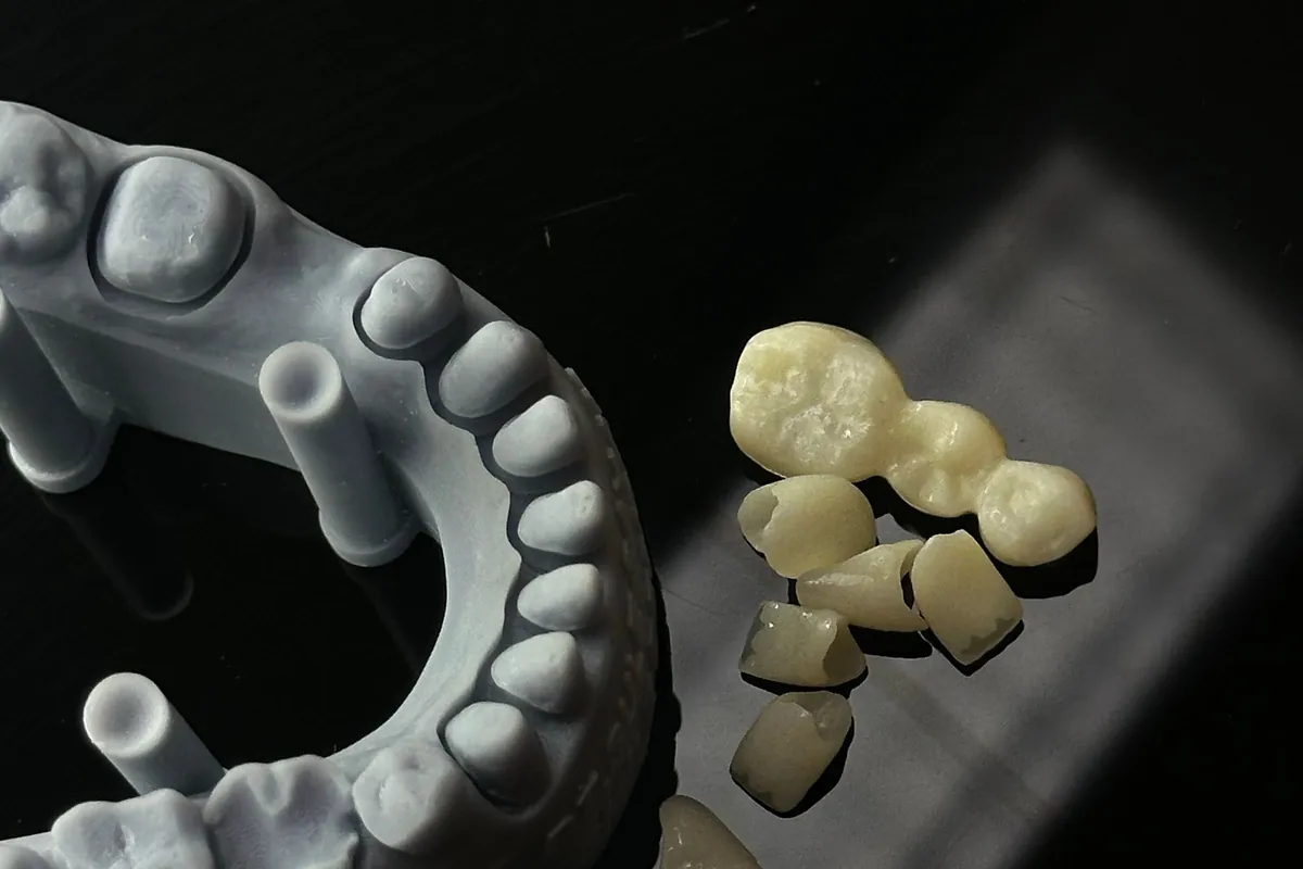 Coronas dentales de cerámica junto a un modelo impreso en 3D en el laboratorio