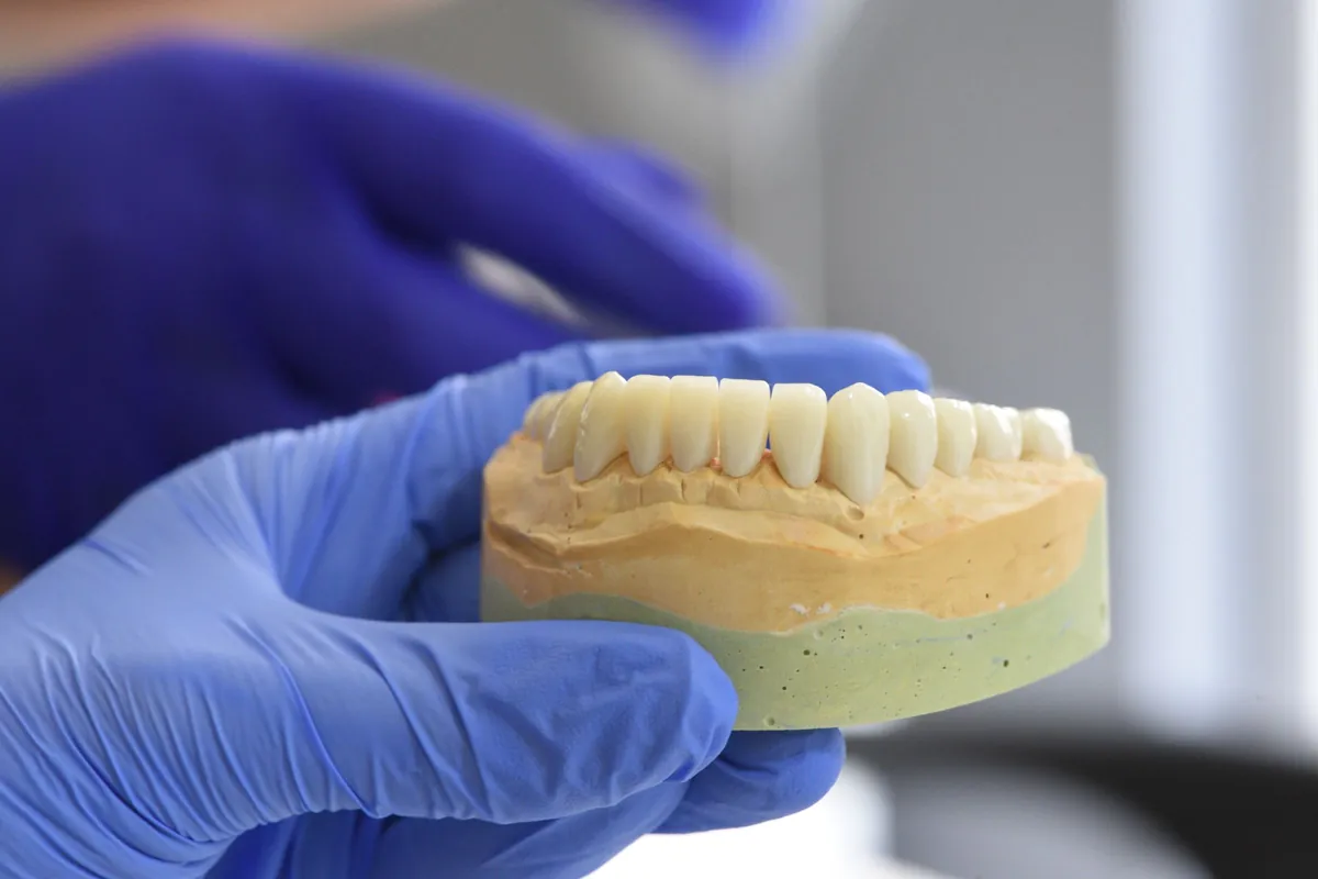 Modelo de escayola con los dientes montados, una fase de laboratorio en la fabricación de una dentadura postiza
