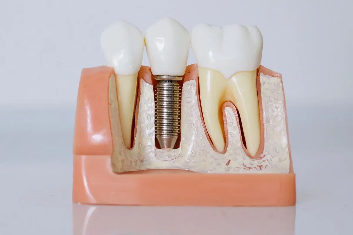 Maqueta de un implante dental integrado en el hueso, el anclaje de una dentadura postiza sobre implantes