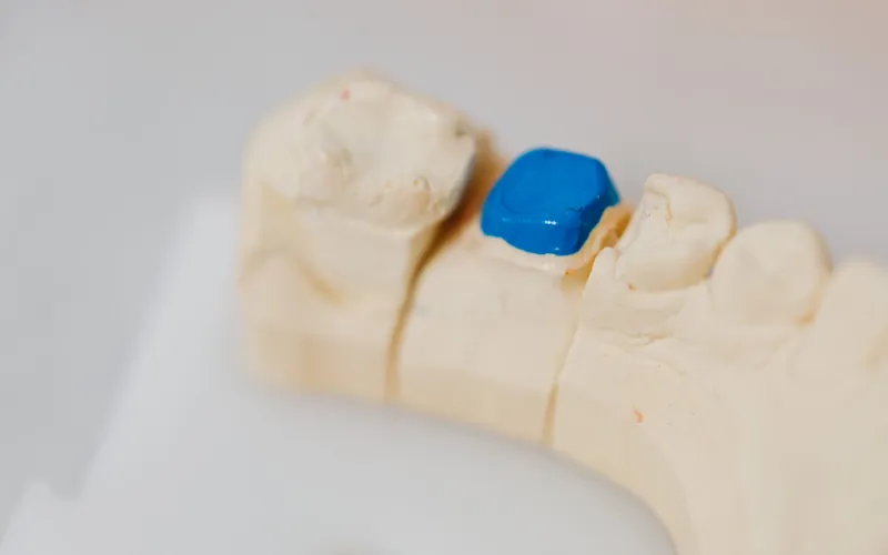 Modelo dental de escayola con una restauración azul sobre una muela, como una incrustación dental