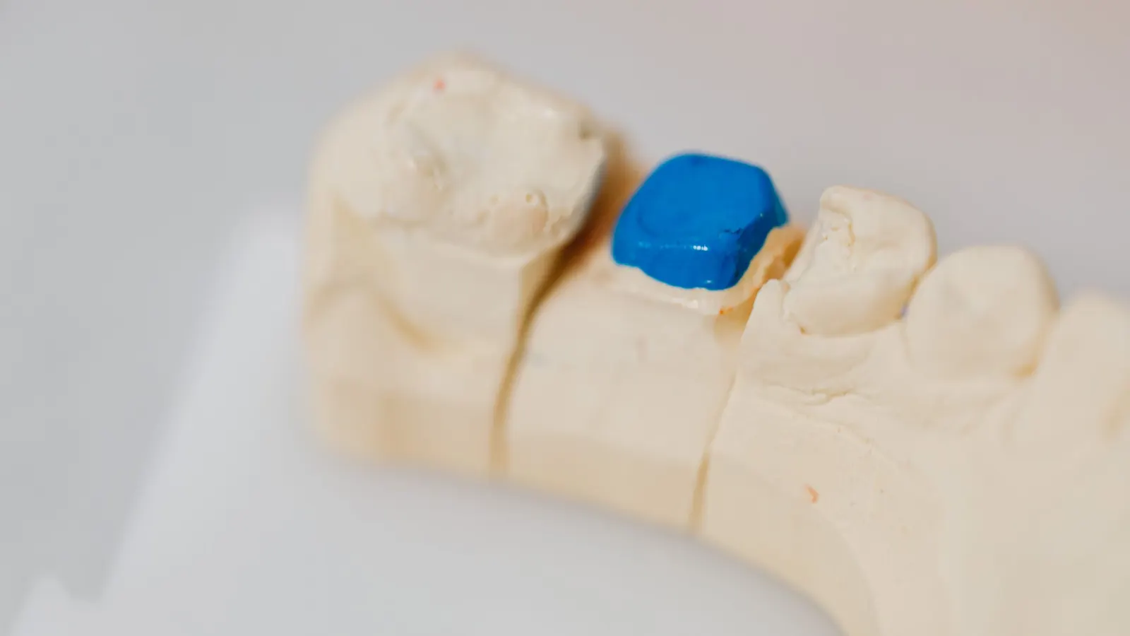 Modelo dental de escayola con una restauración azul sobre una muela, como una incrustación dental