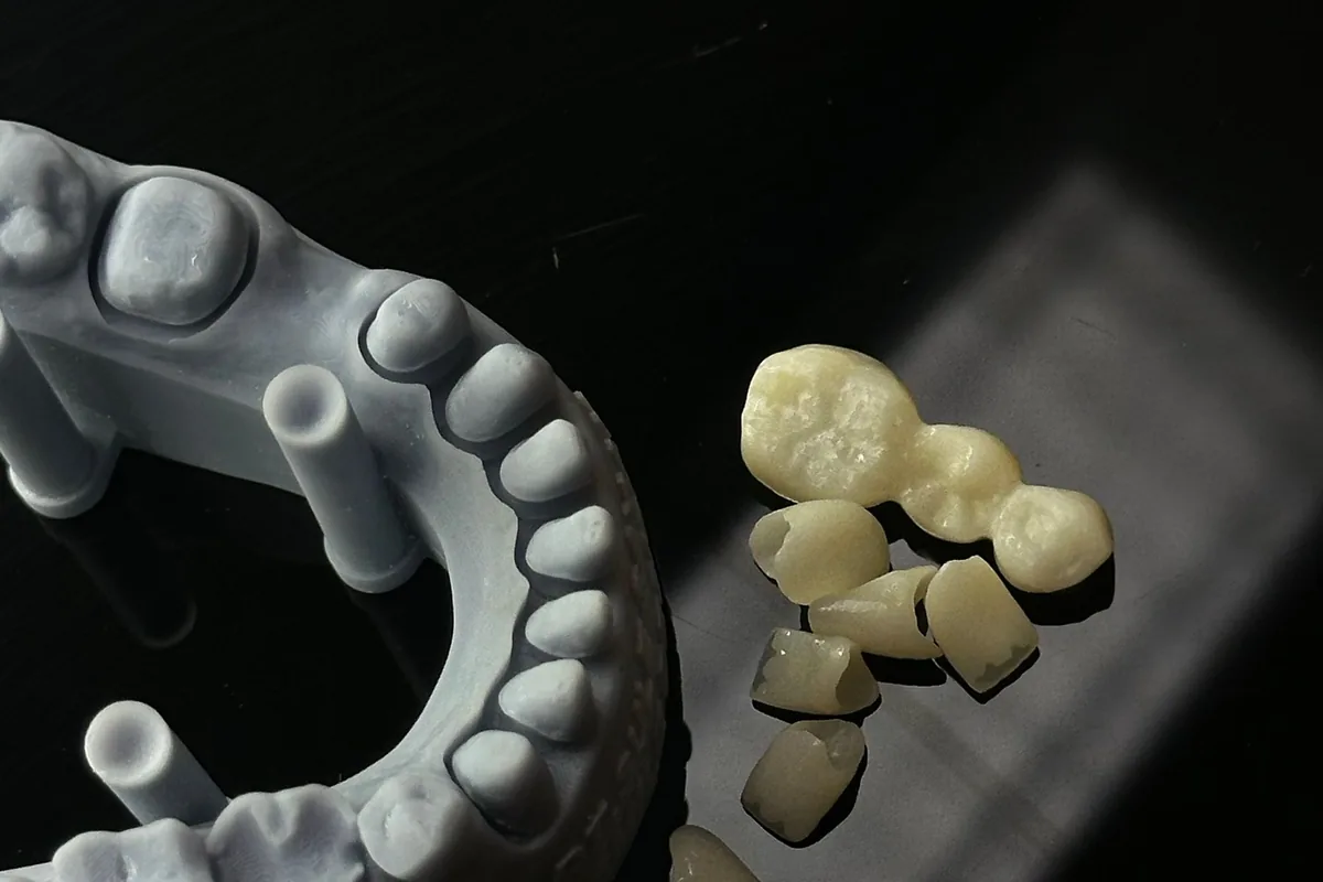 Modelo impreso con los dientes tallados junto a las coronas fabricadas para ese caso
