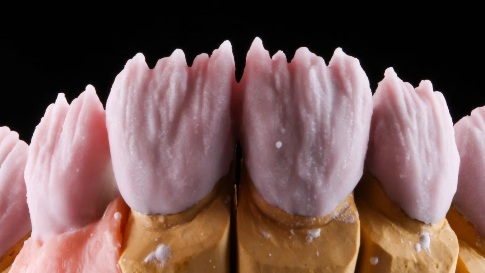 Coronas modeladas en cera rosa sobre muñones de escayola en el laboratorio, con el cuello de cada pieza a la vista