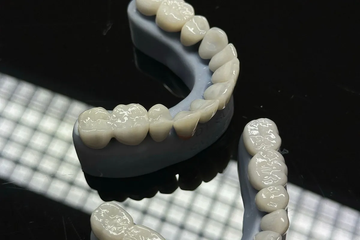 Prótesis dental fija de arcada completa con coronas cerámicas sobre un modelo impreso