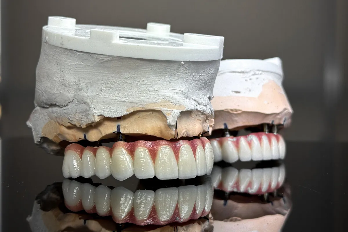 Prótesis de arcada completa con dientes y encía rosa sobre sus modelos, como una prótesis híbrida