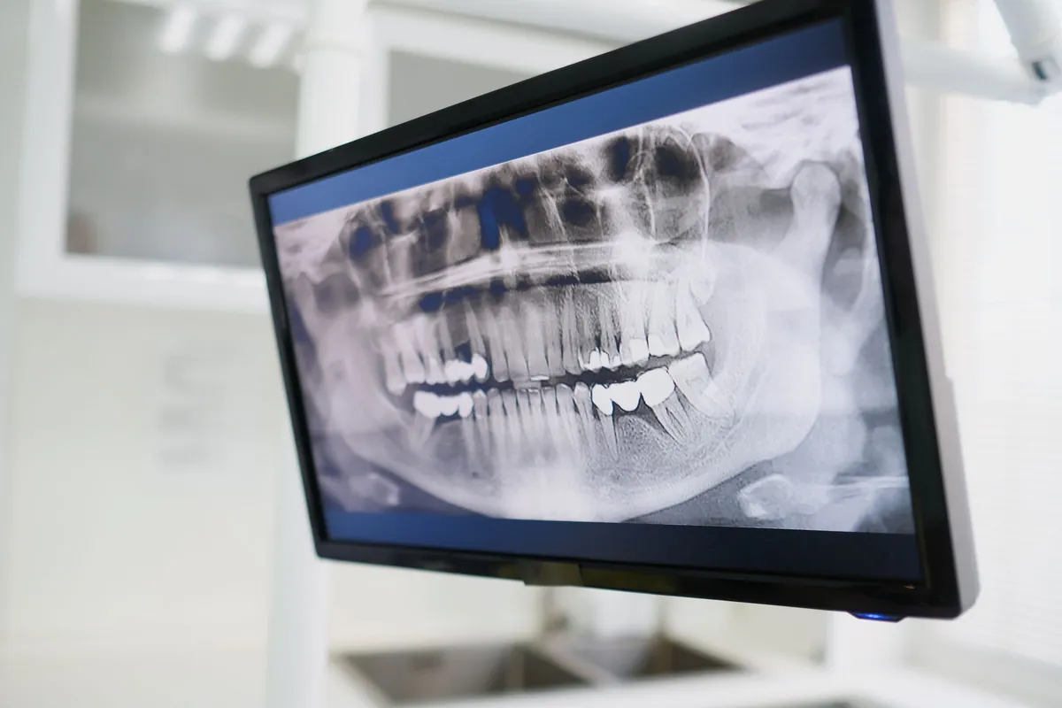 Radiografía panorámica en el monitor para valorar el hueso disponible antes de una prótesis híbrida