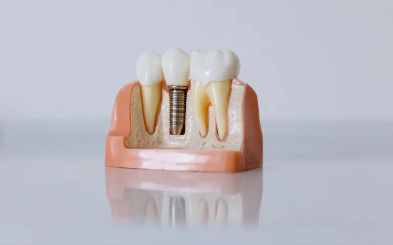Maqueta dental con un implante de titanio y su corona que muestra cómo es una prótesis sobre implantes
