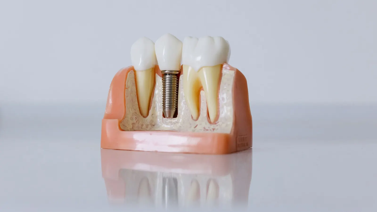Maqueta dental con un implante de titanio y su corona que muestra cómo es una prótesis sobre implantes