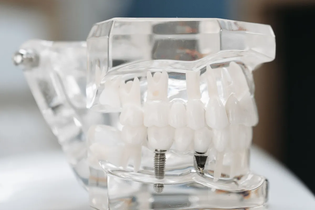 Modelo dental transparente con implantes colocados para explicar los tipos de prótesis sobre implantes