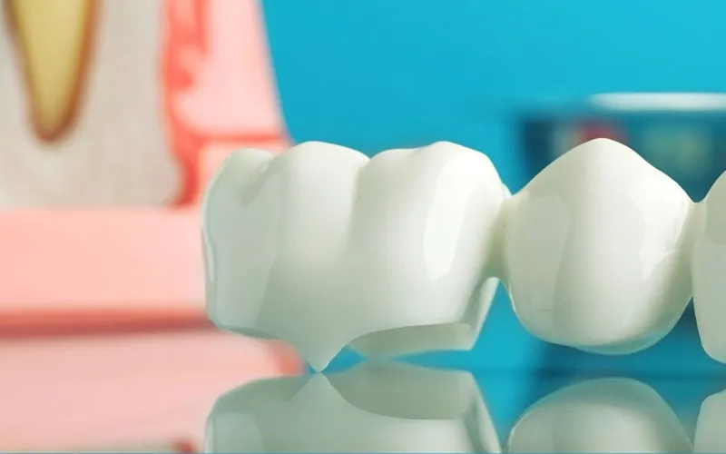 Puente dental de cerámica de varias piezas junto a un modelo anatómico de diente