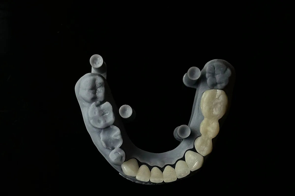 Puentes dentales cerámicos sobre modelos impresos en 3D en el laboratorio