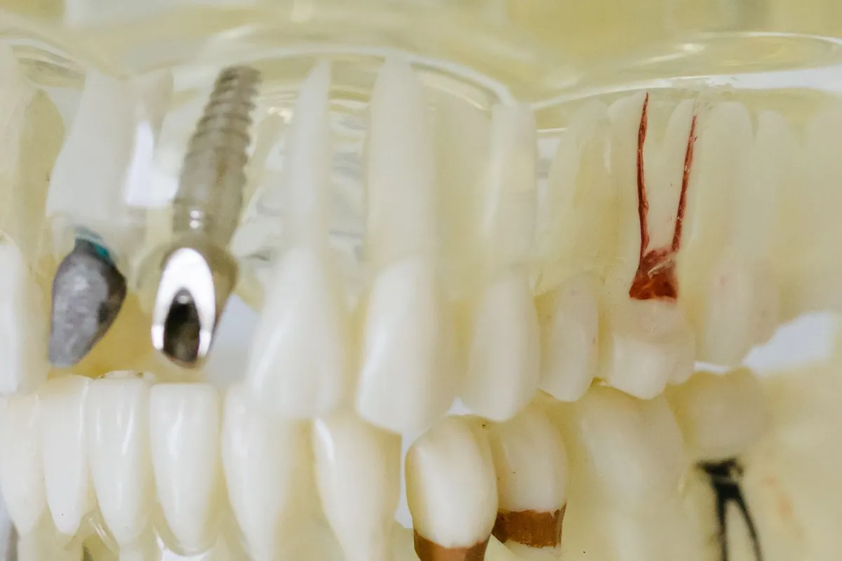 Detalle de un implante con su pilar en un modelo transparente, el punto de anclaje de una sobredentadura