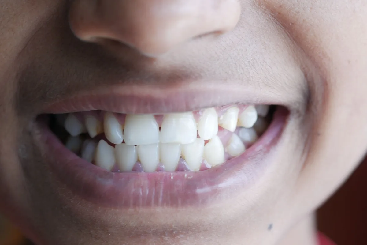 Sonrisa con dientes de formas y posiciones irregulares y pequeños espacios junto a la encía