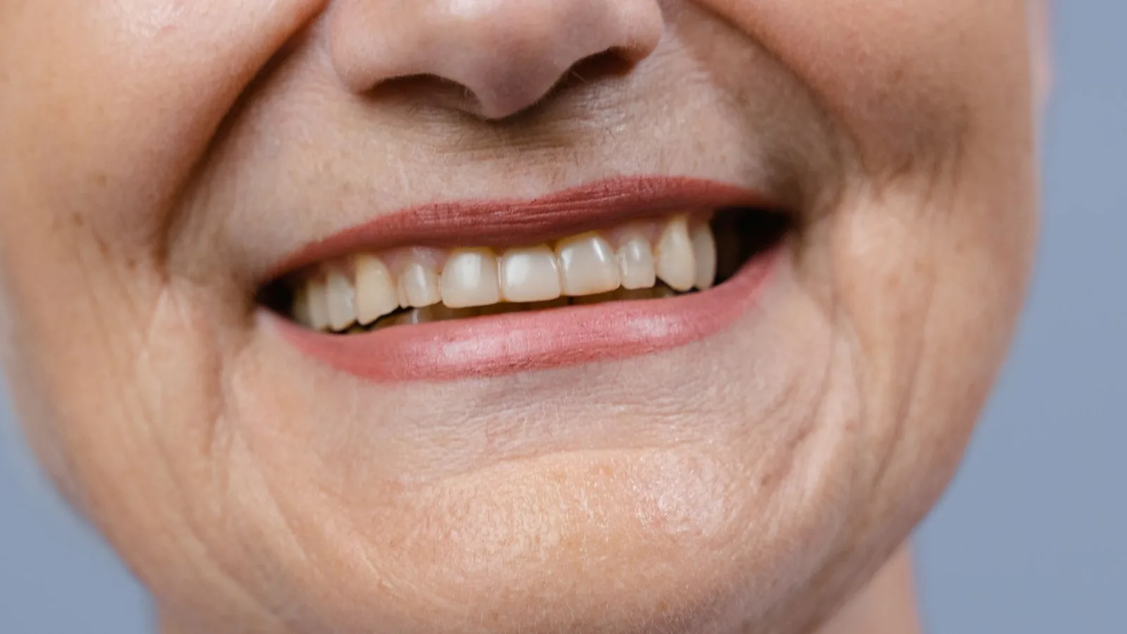Sonrisa natural de una persona mayor con pequeños espacios oscuros junto a la encía entre algunos dientes