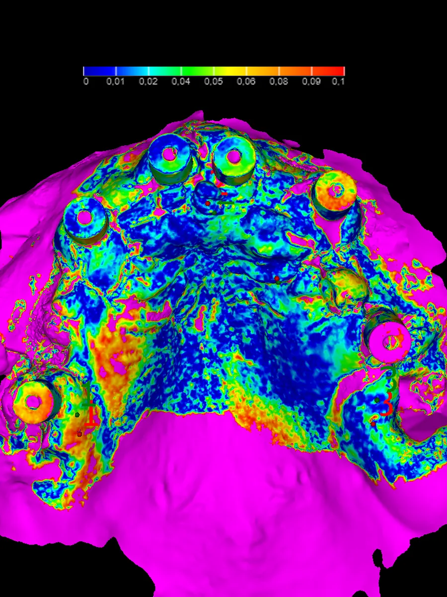 Archivos intraorales: escaneo digital analizado en mapa de color