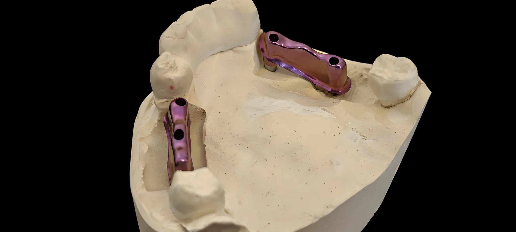 Modelo de trabajo con barra atornillada sobre implantes
