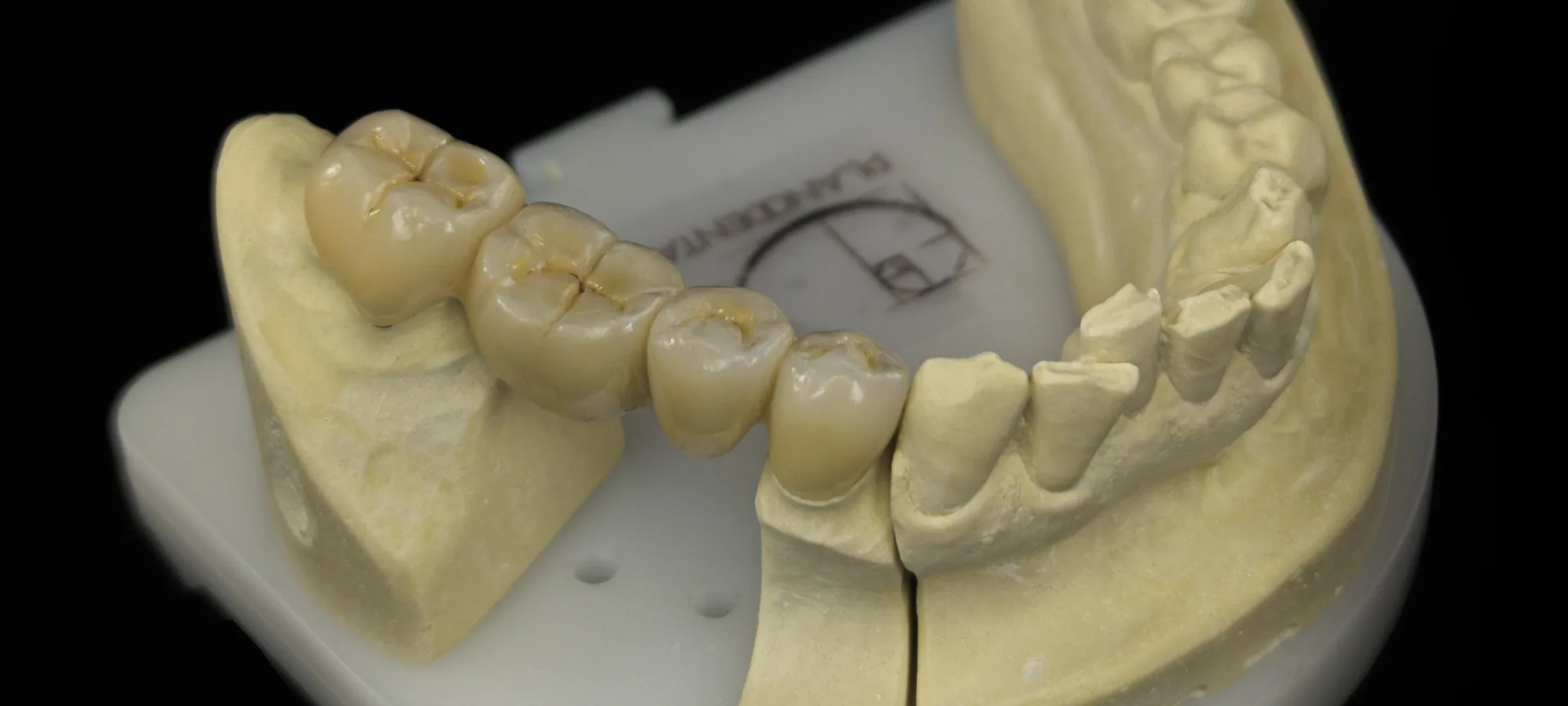 Modelo de trabajo con una restauración dental terminada