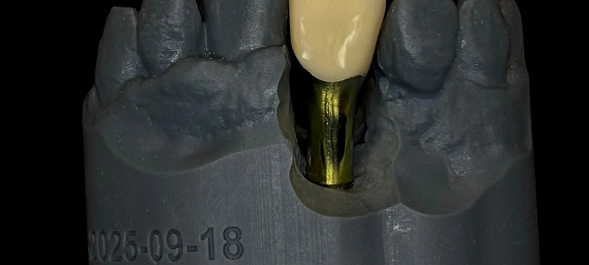 Corona sobre modelo de trabajo impreso en el laboratorio