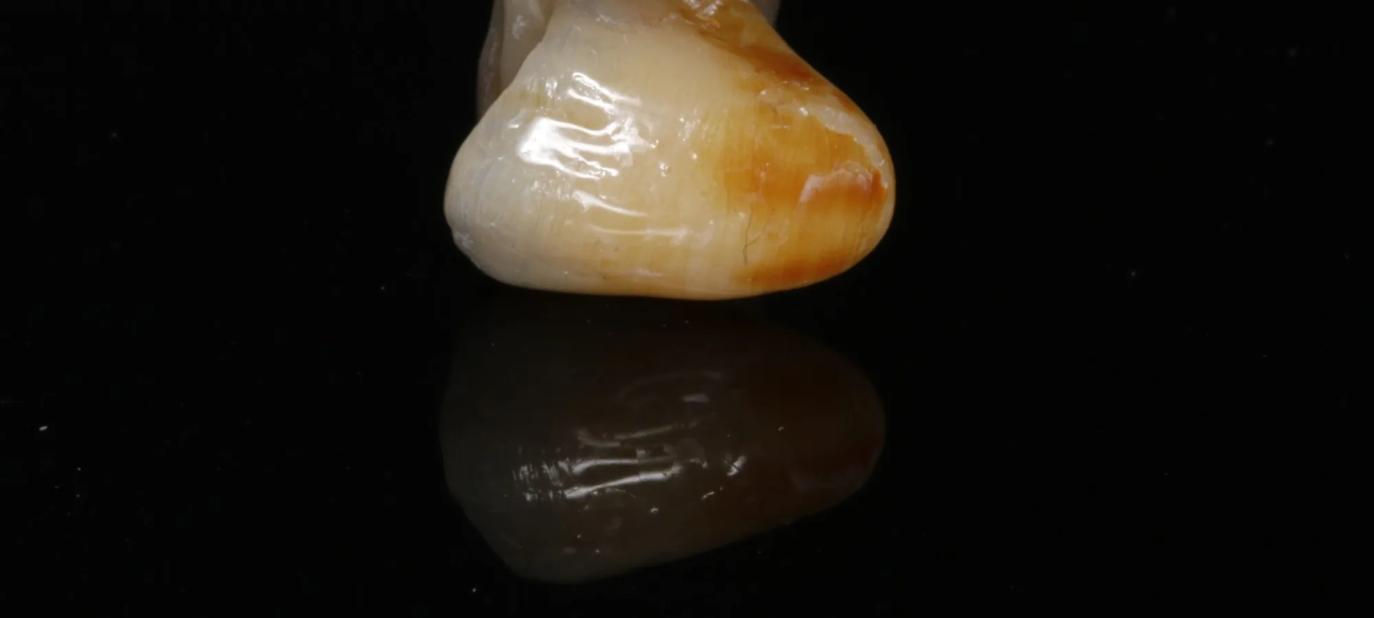 Corona de zirconio monolítico con caracterización externa