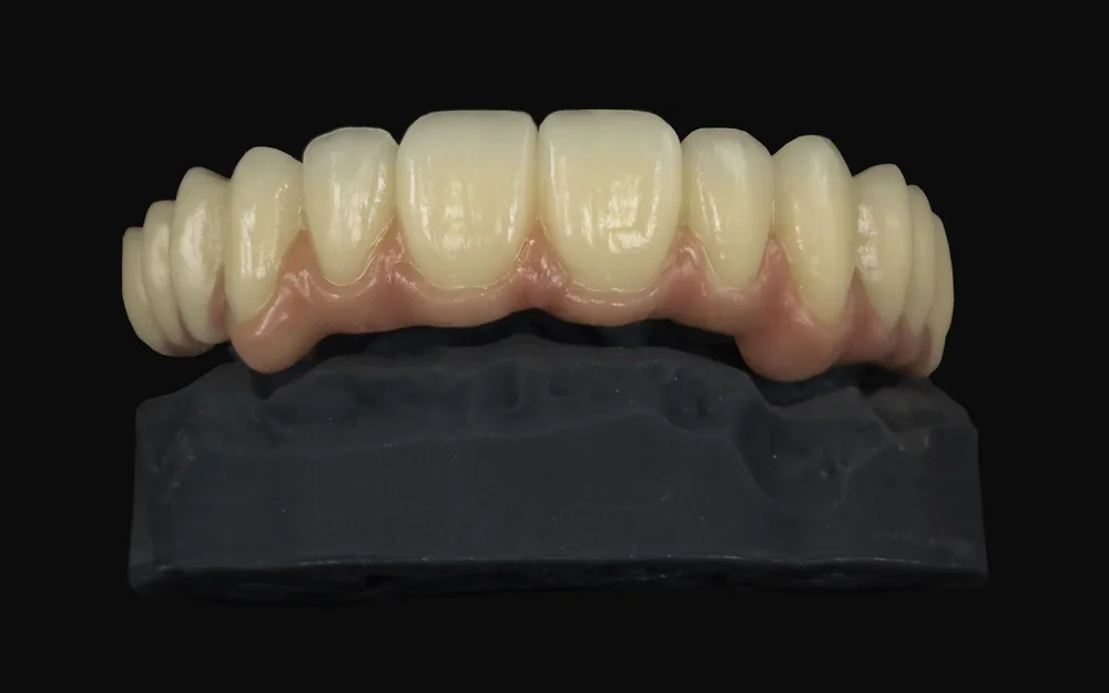 Prótesis híbrida atornillada para carga inmediata sobre implantes