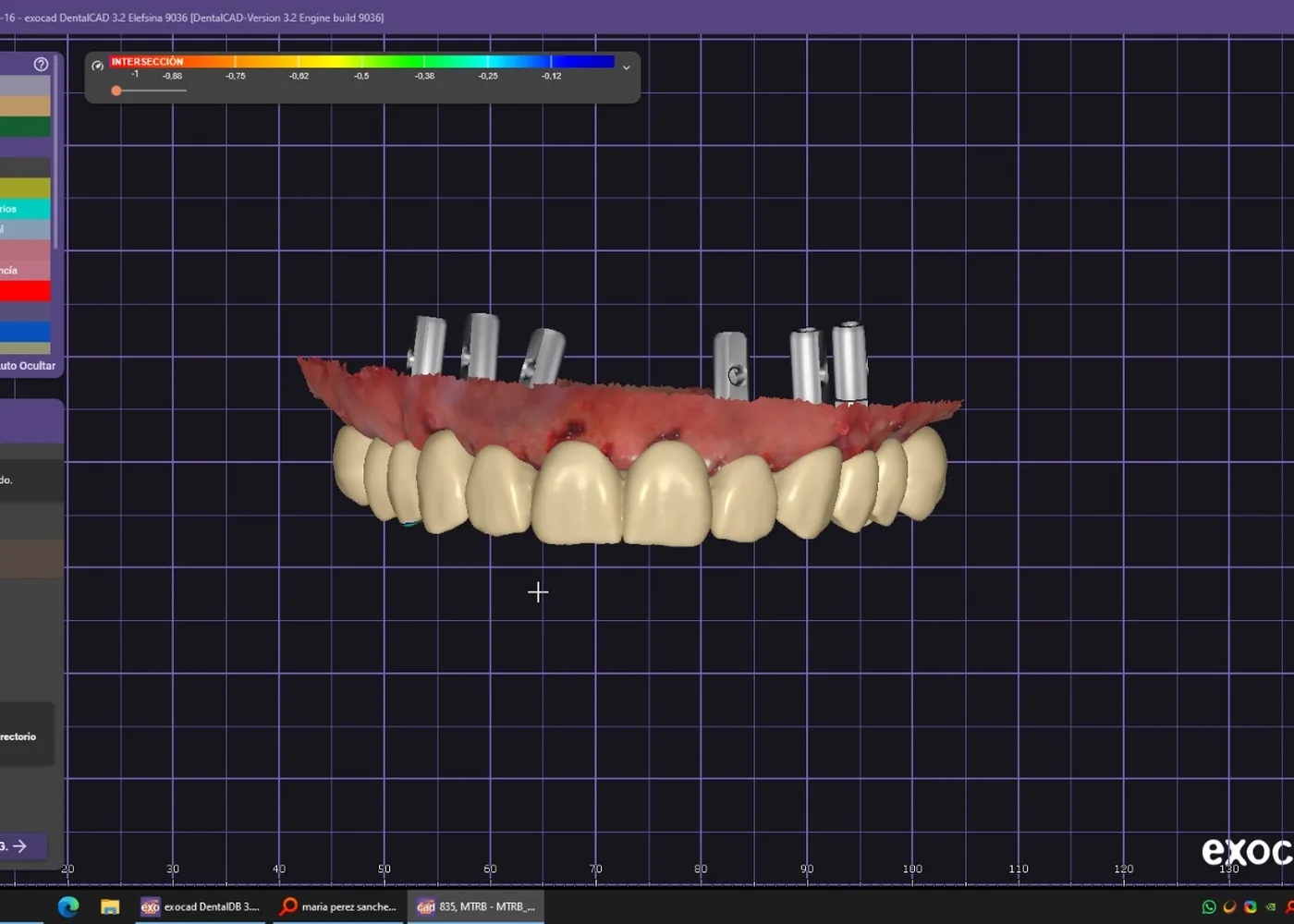 Diseño CAD·CAM de una prótesis sobre implantes en el software del laboratorio