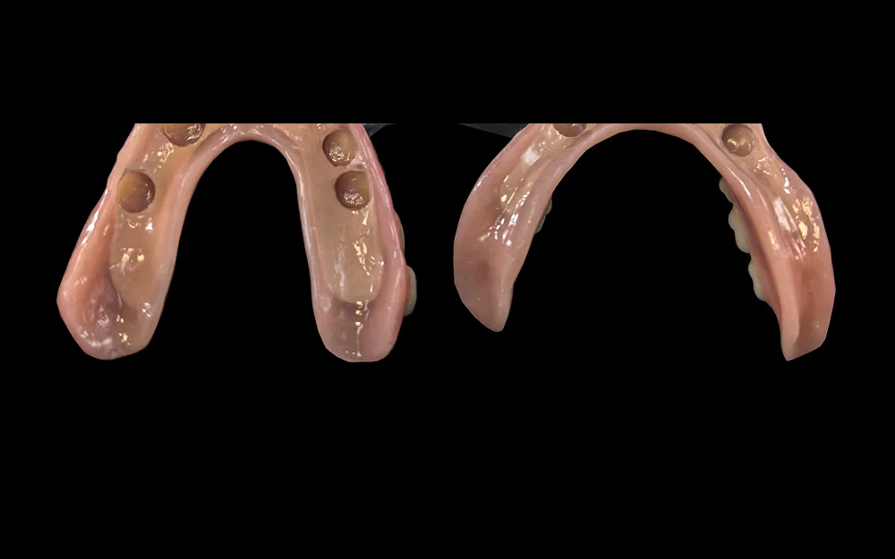 Parcial removible de acetal sin metal fabricado en Plano Dentalab