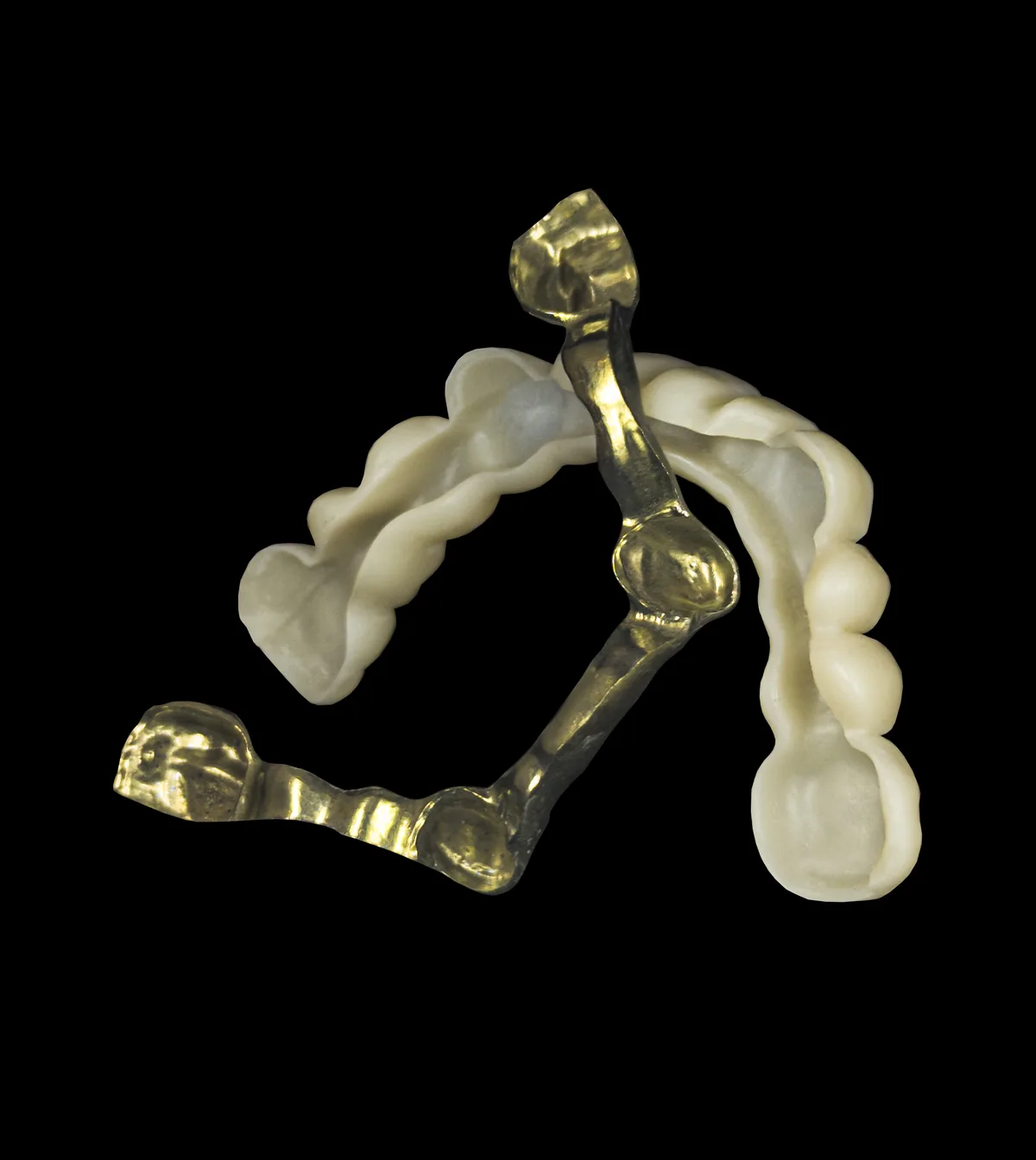 Estructura atornillada sobre implantes, con barra metálica, fabricada en nuestro laboratorio de Córdoba