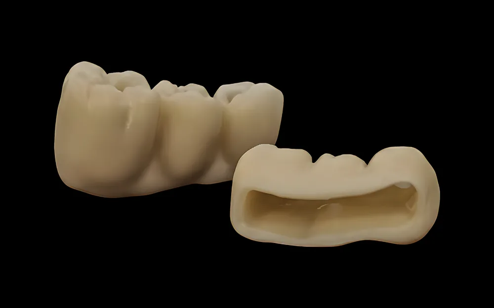 Corona de zirconio monolítico fresada, sin capa de porcelana