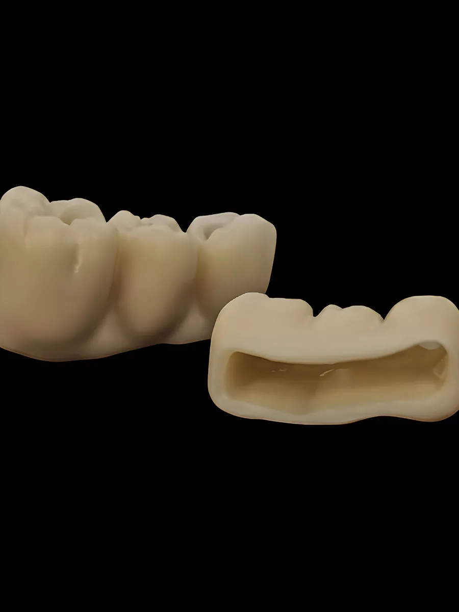 Zirconio monolítico de alta translucidez con maquillaje externo, sin porcelana